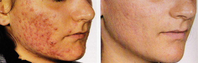 Antes e após tratamento com Isotretinoína oral